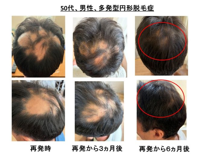 円形脱毛症　病院
